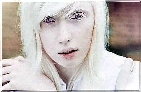 Living with albinism: More than physical appearance