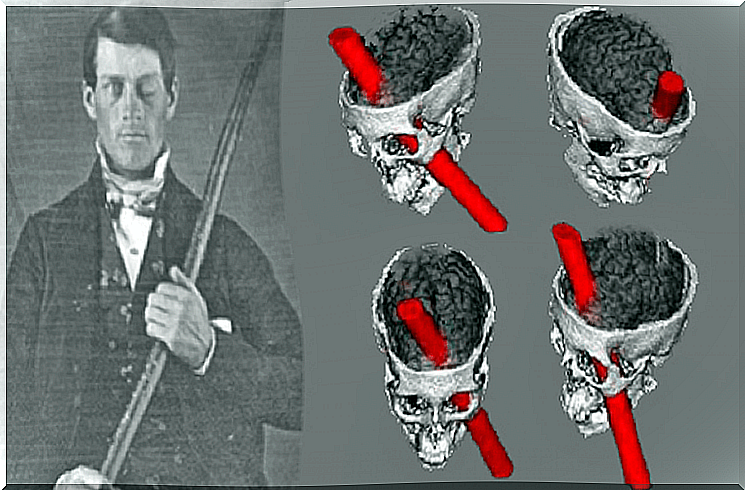 Phineas Gage is an example of an exciting clinical case